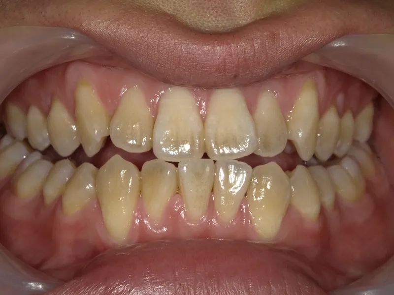 20代男性ホワイトニングビフォー