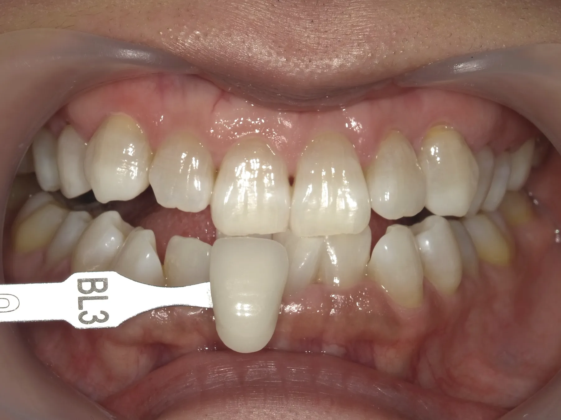 ２０代女性ホワイトニングアフター