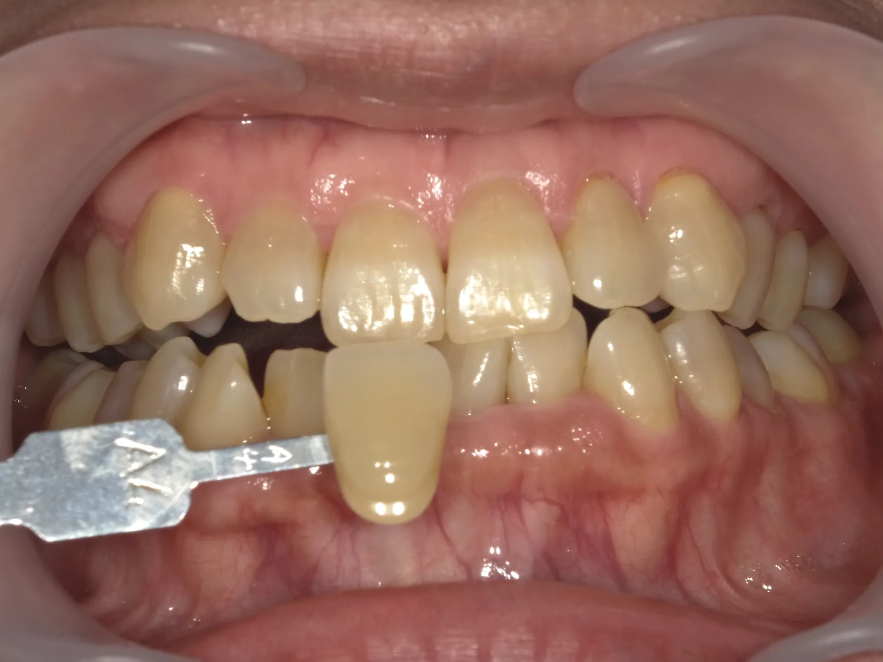 ２０代女性ホワイトニングビフォー