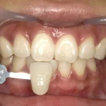 ２０代女性　セルフホワイトニングでなかなか白くならず来院した症例