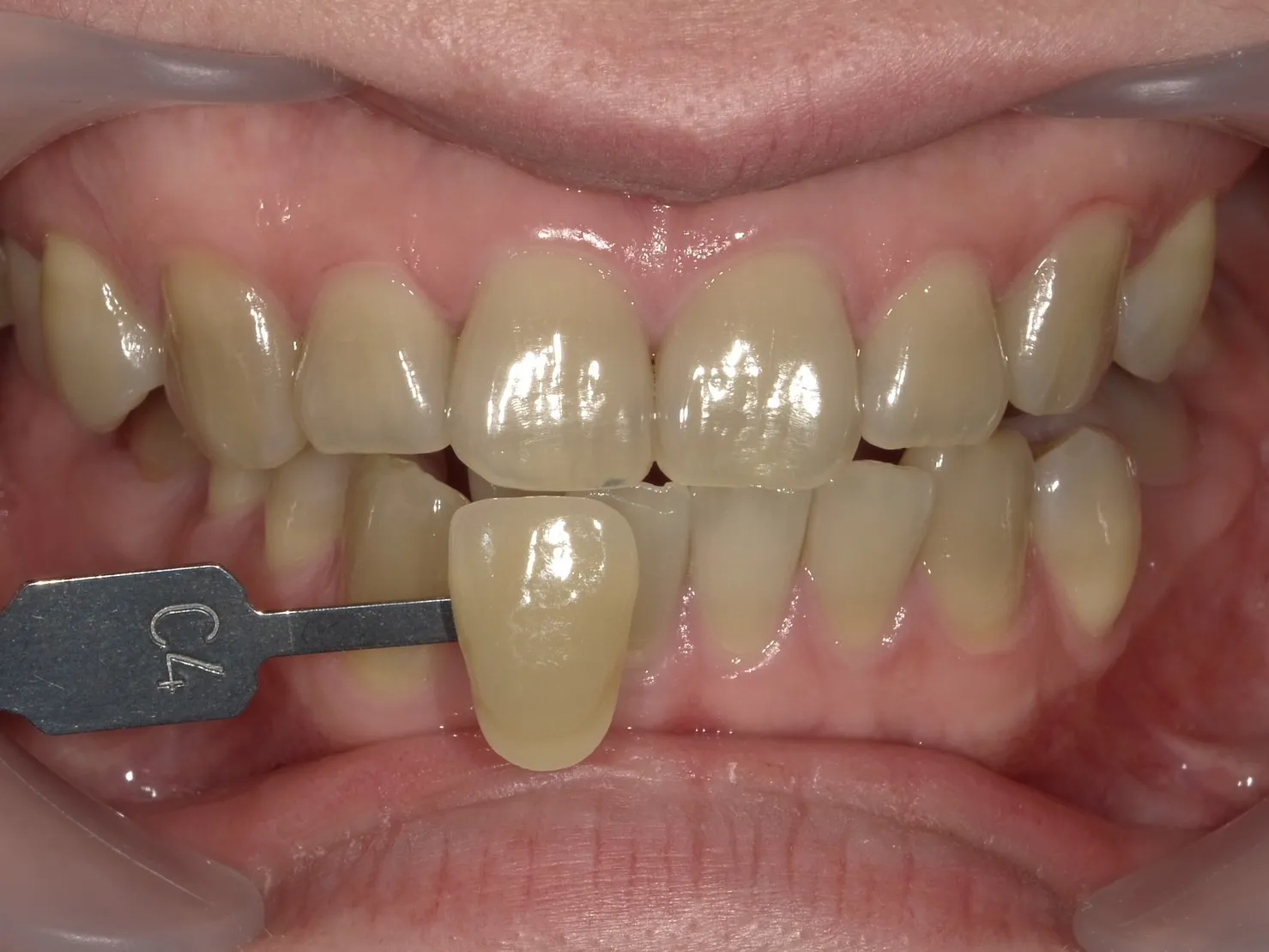 ３０代女性ホワイトニングビフォー