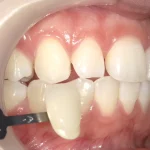 20代女性　矯正後にリテーナーでホワイトニングしたいという希望の症例