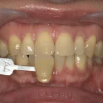 50代女性　マスクを外すまでに歯を白くしたいと来院した症例