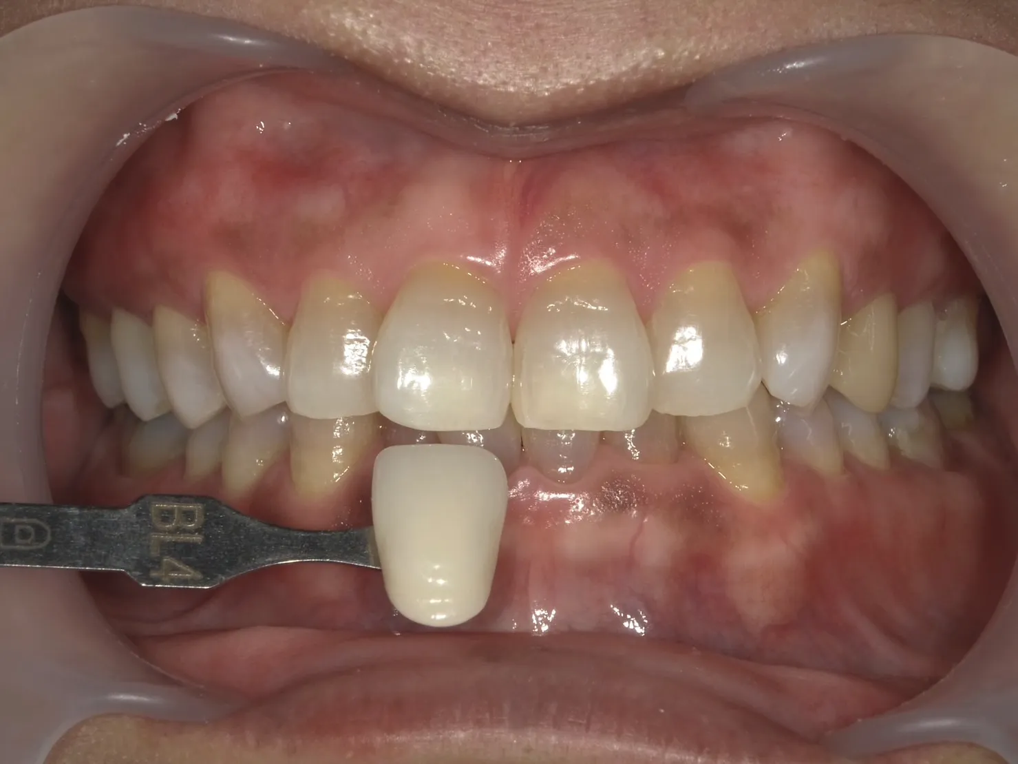 20代男性ホワイトニングアフター