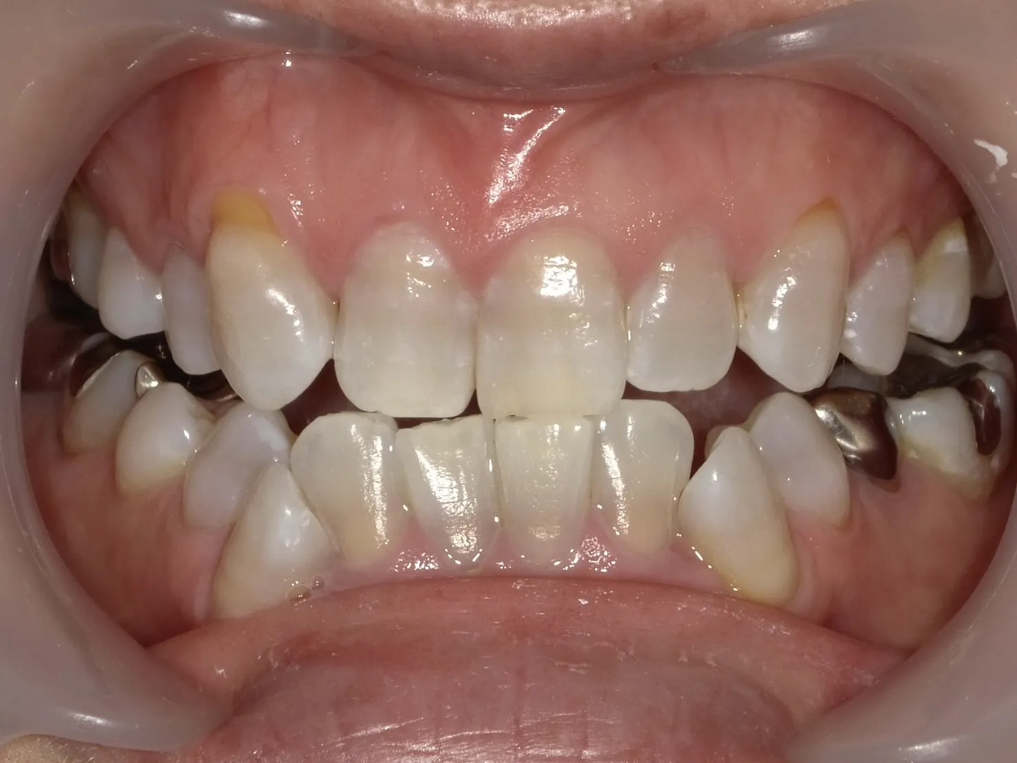 ５０代女性ホワイトニングアフター