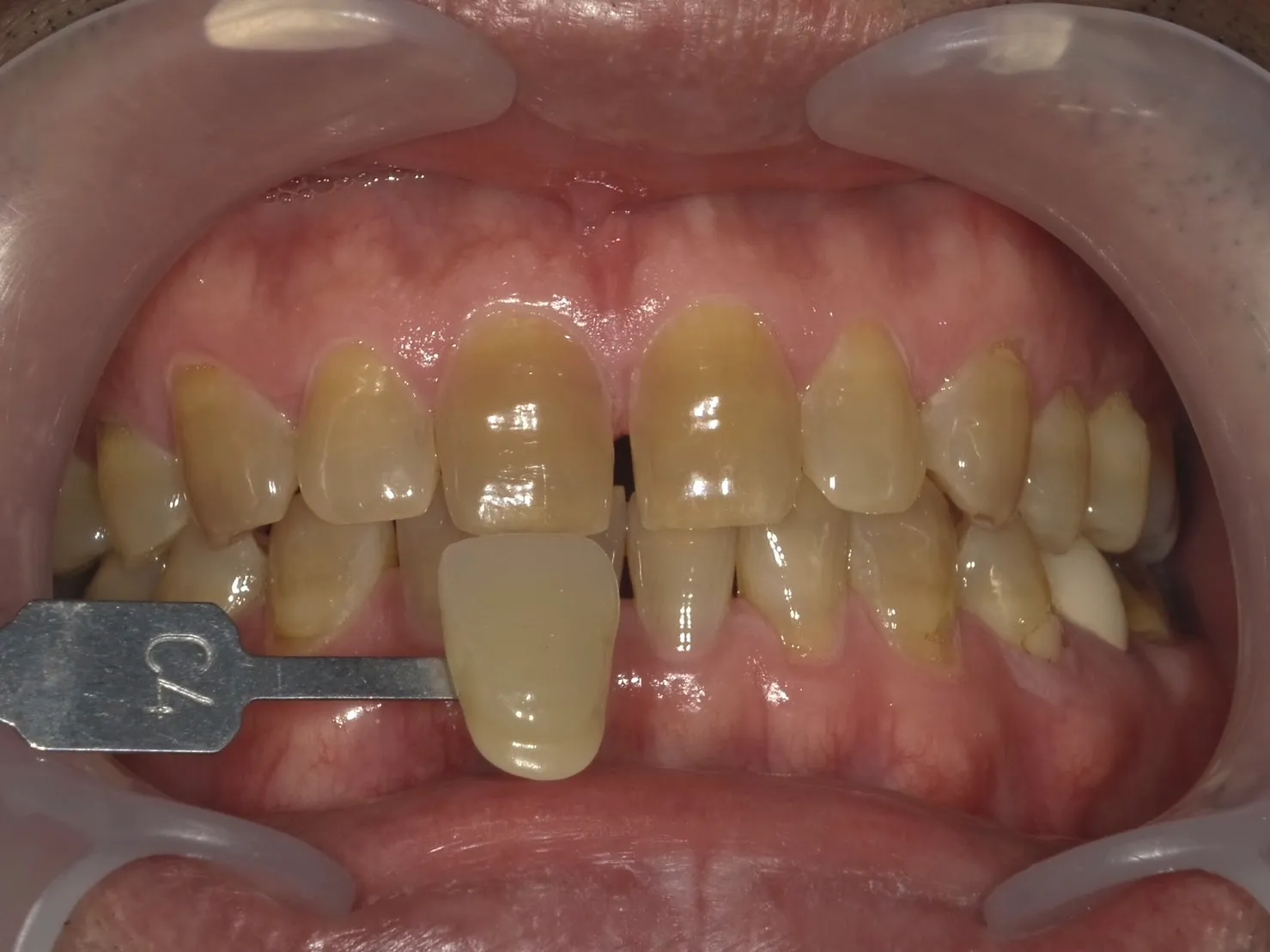 ４０代男性ホワイトニングビフォー