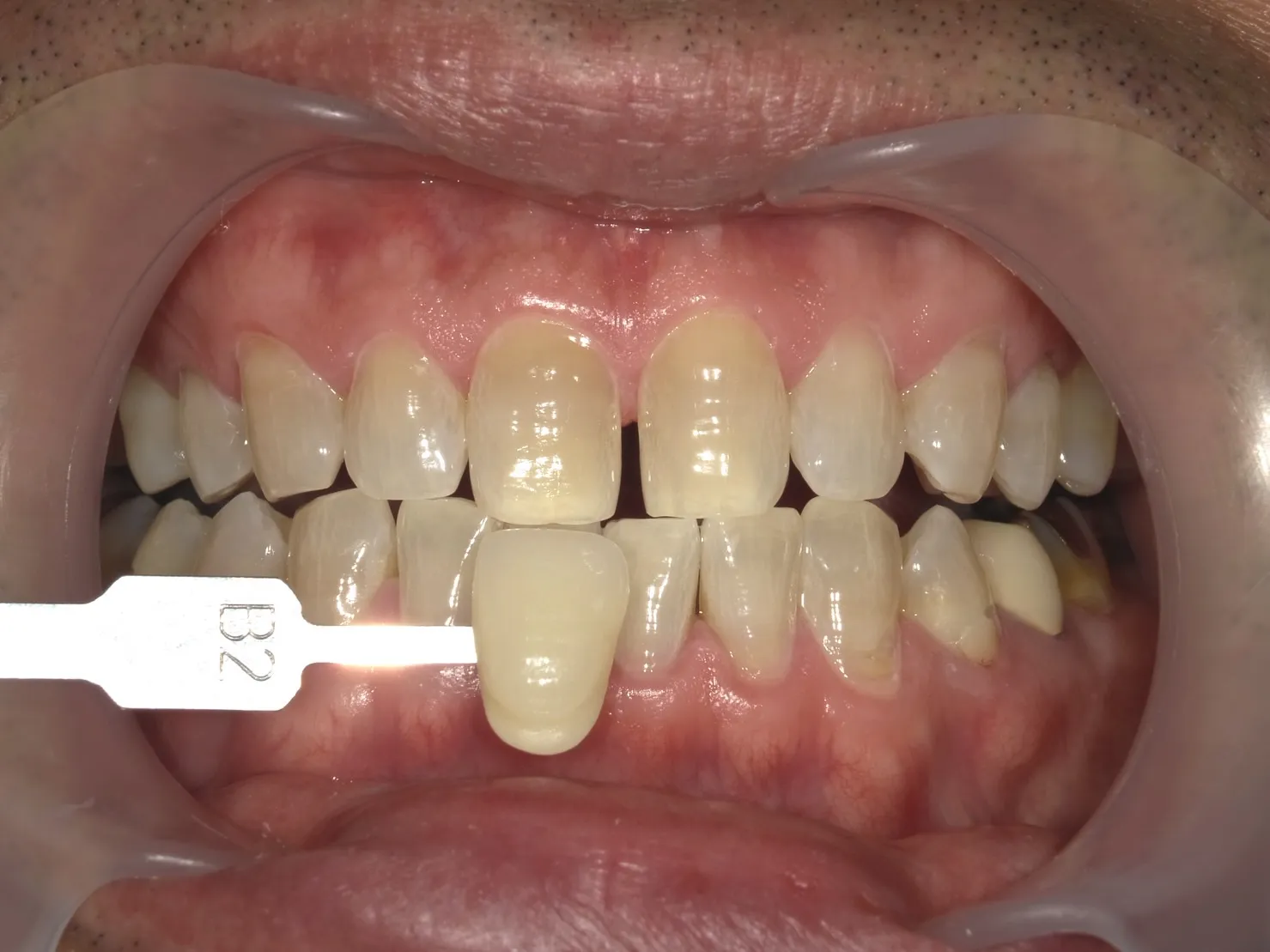 ４０代男性ホワイトニングアフター