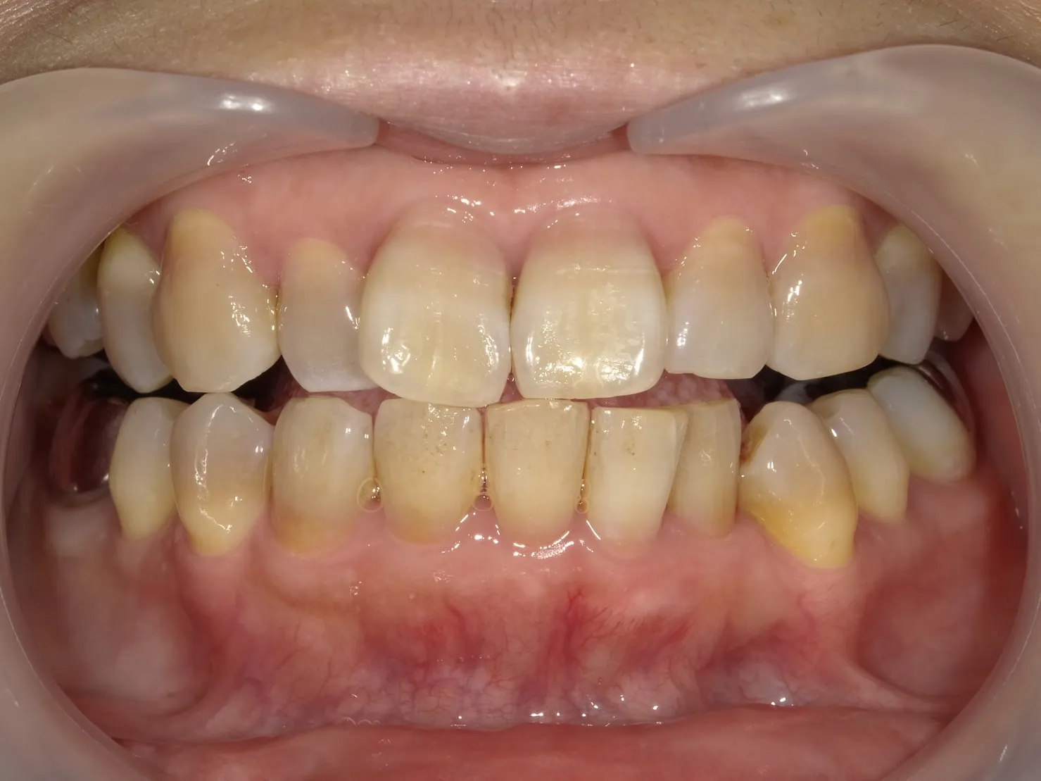 ５０代男性 ホワイトニングビフォー