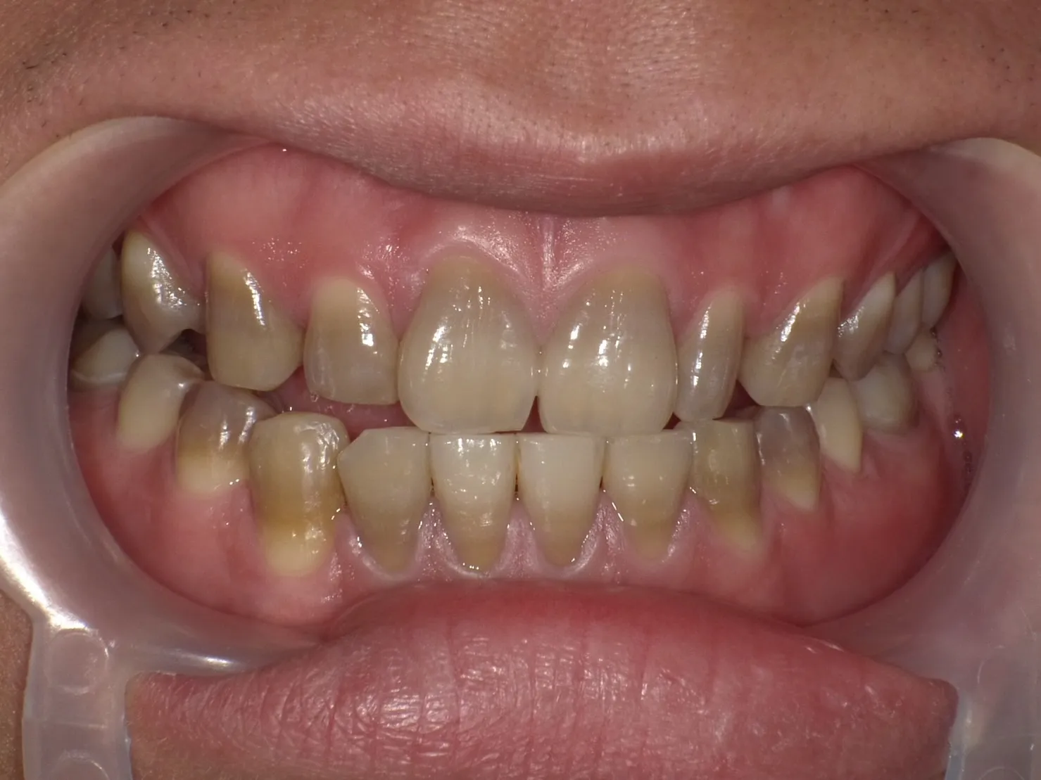 不均一な着色パターン