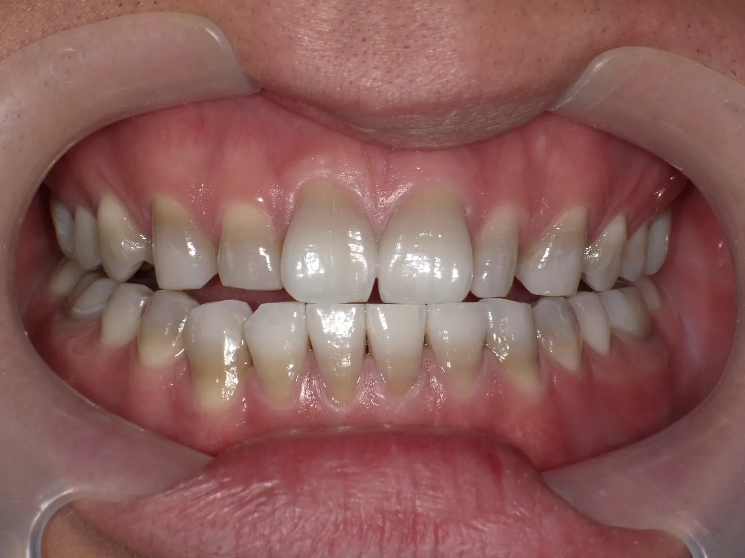 ５０代男性 ホワイトニングアフター