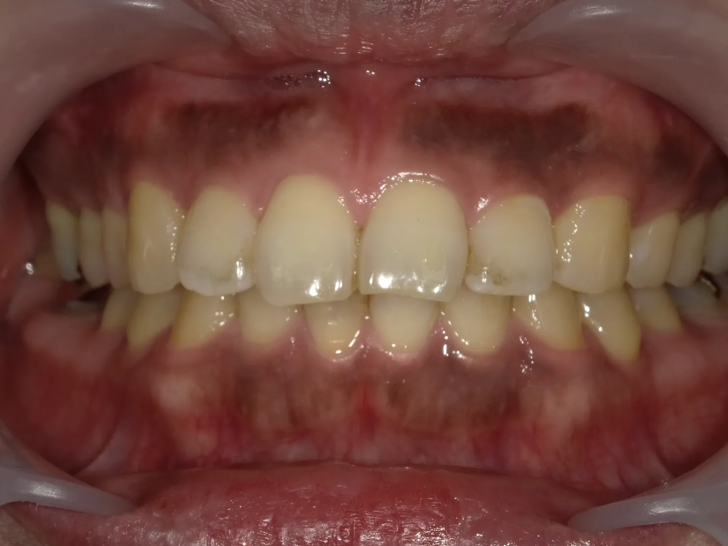 歯ぐきピーリング