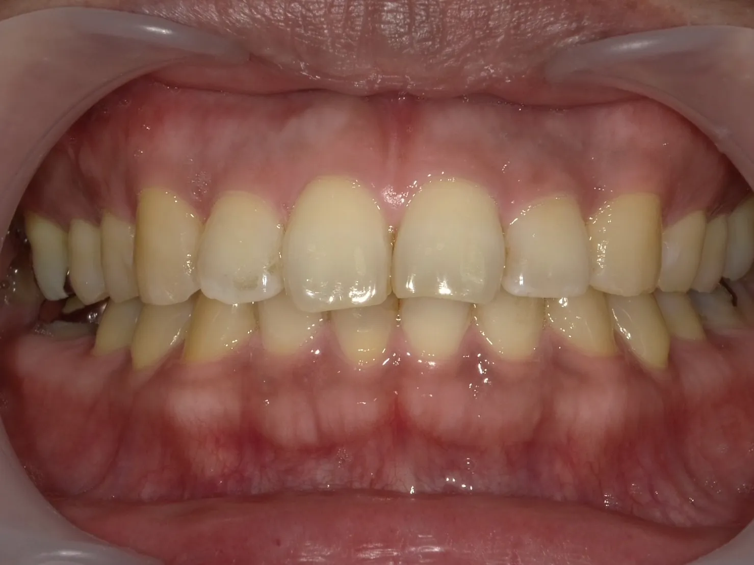 20代男性ホワイトニングアフター