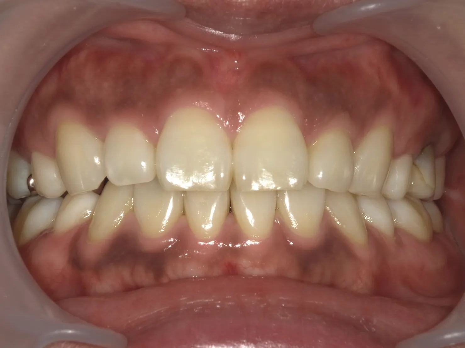 ３０代女性ホワイトニングビフォー