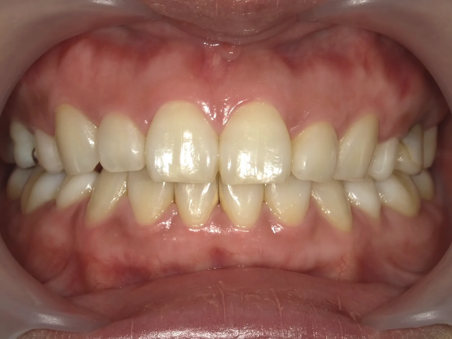 ３０代女性ホワイトニングアフター