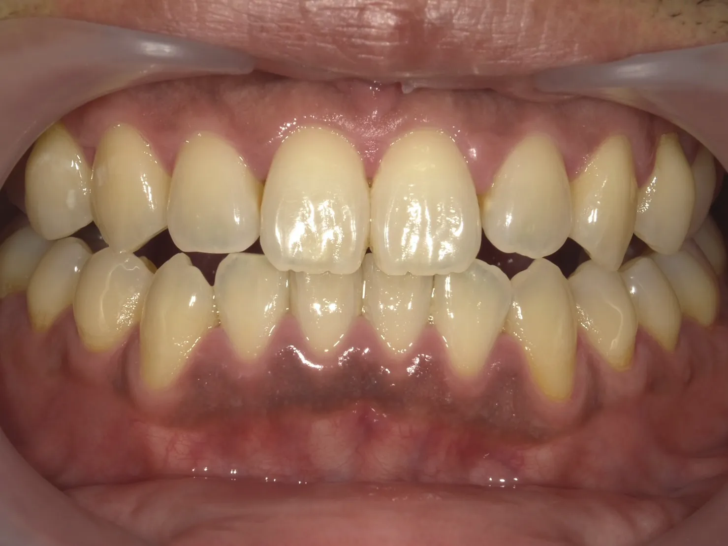 ３０代男性ホワイトニングビフォー