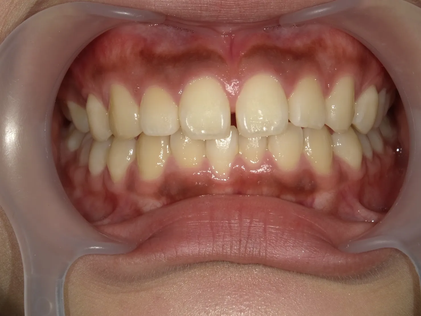 ２０代女性ホワイトニングビフォー