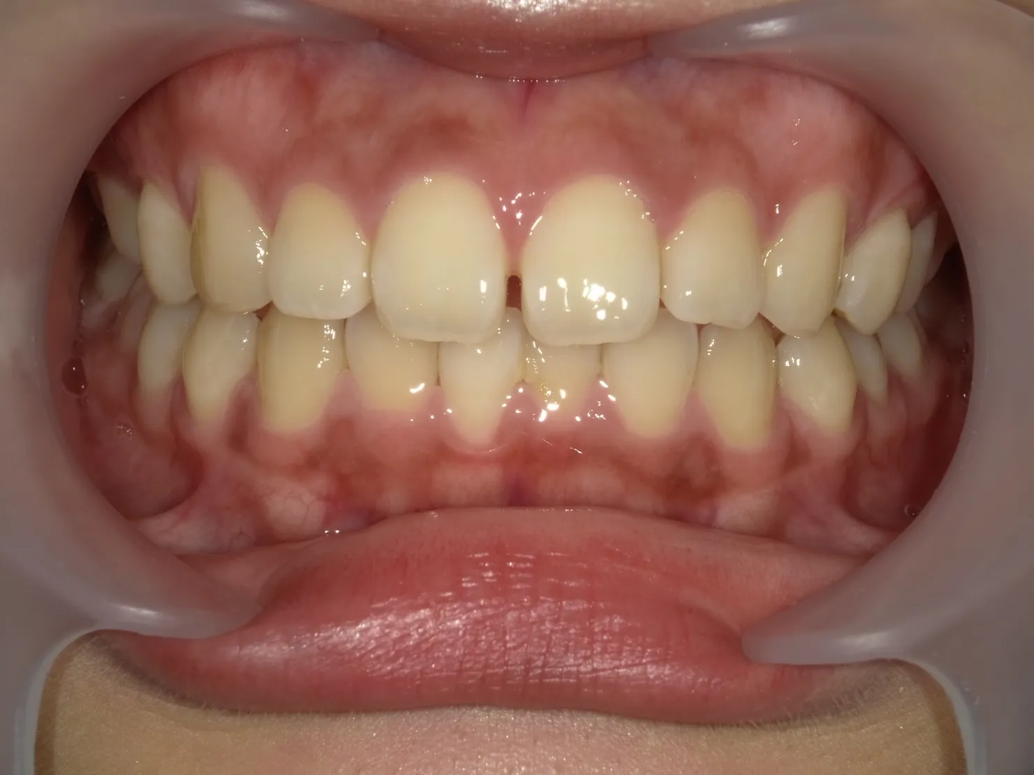 ２０代女性ホワイトニングアフター