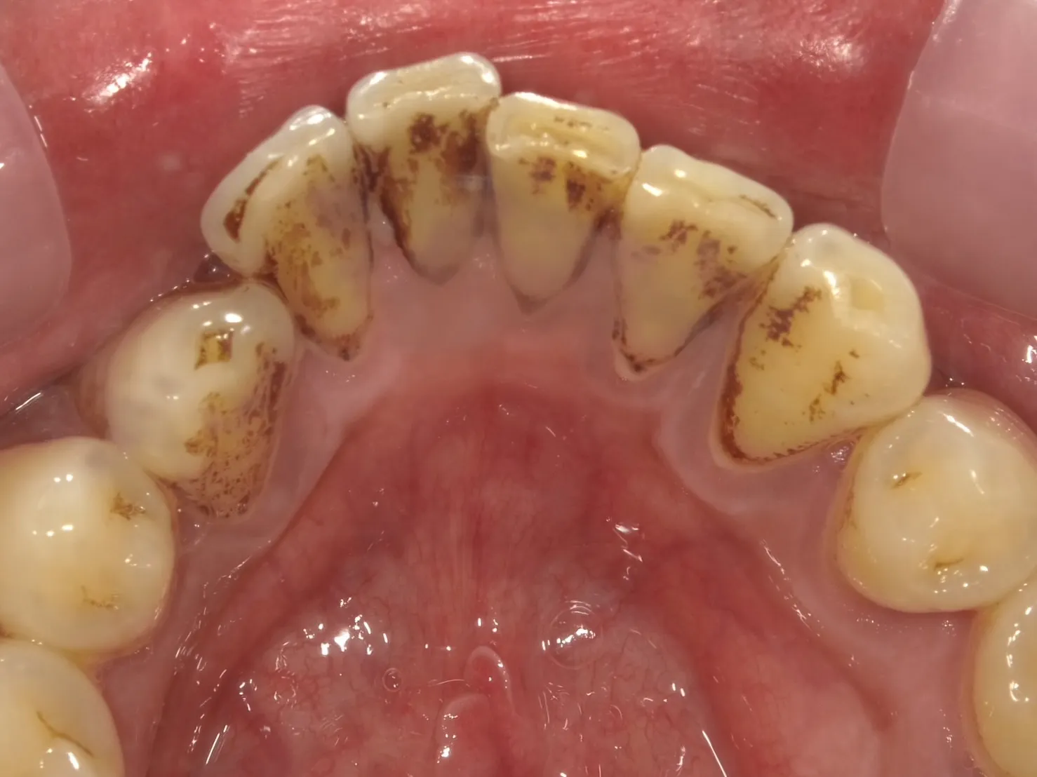 40代男性 喫煙者