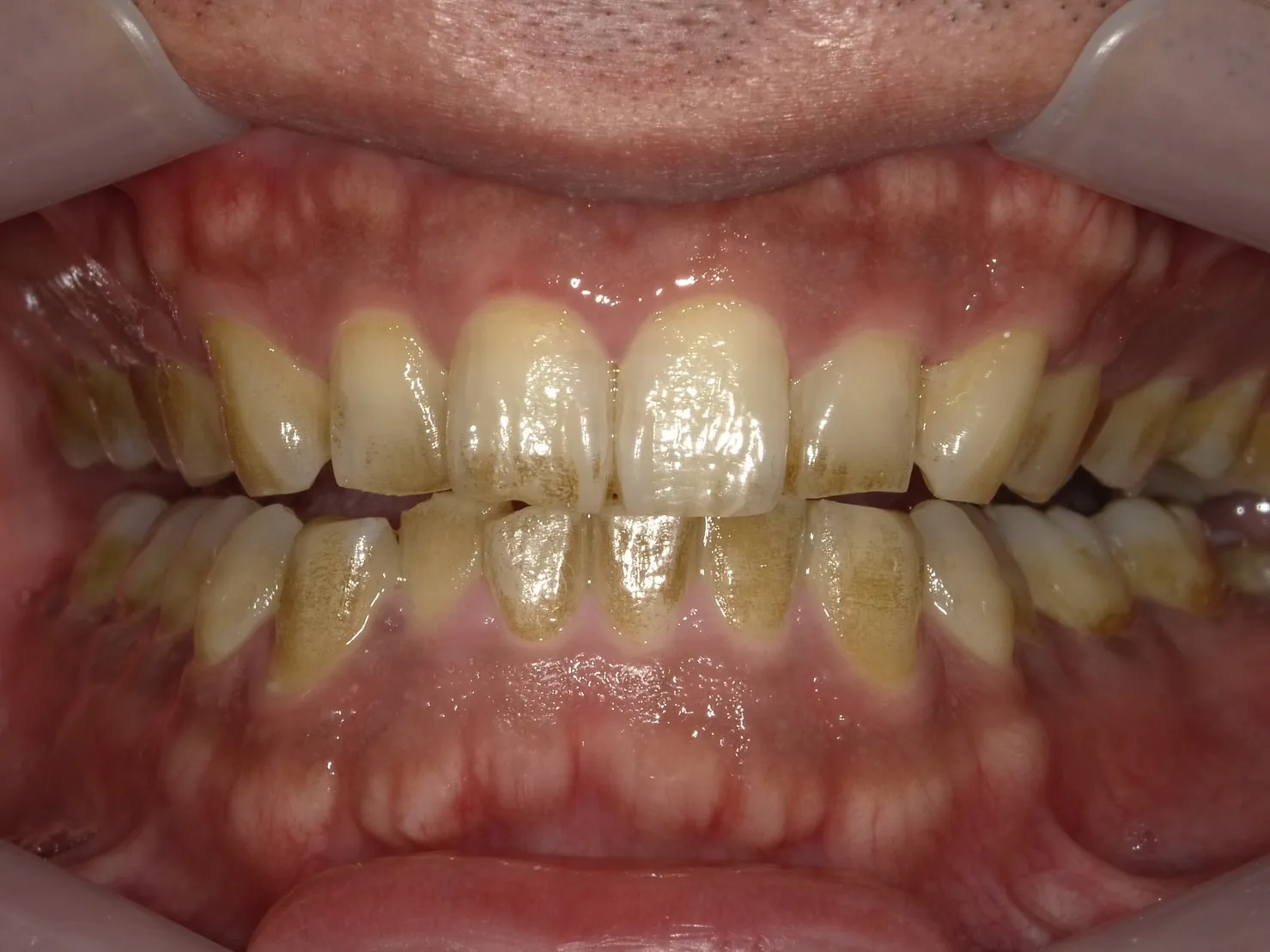 40代男性　着色しやすい