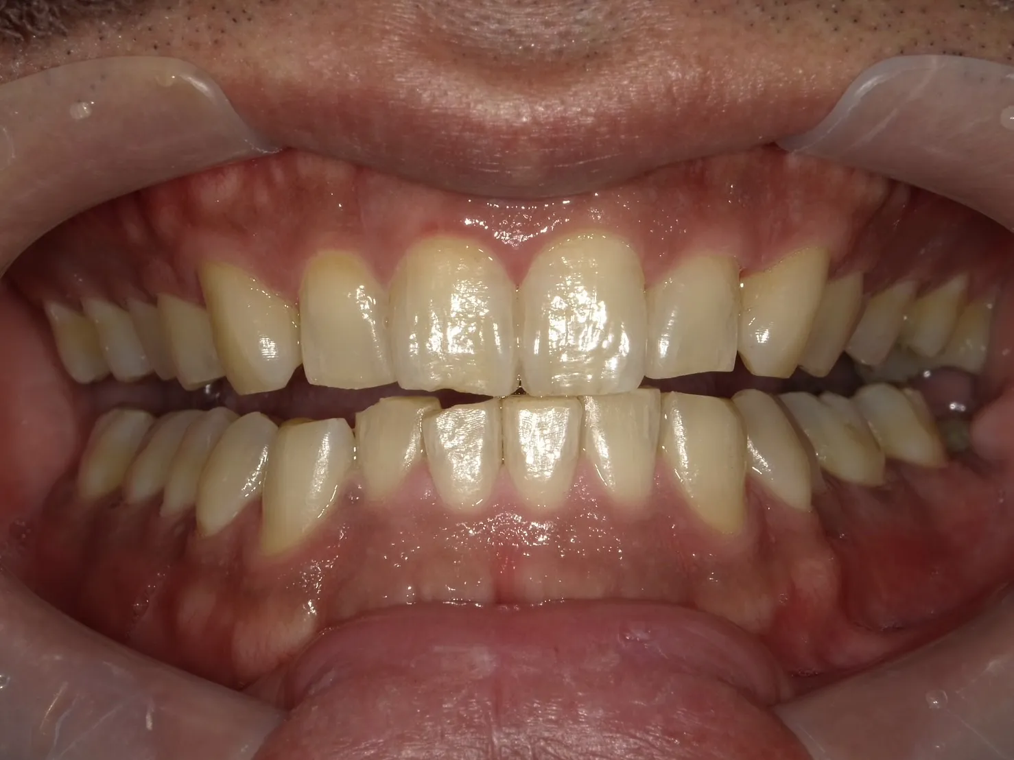 40代男性　着色しやすい