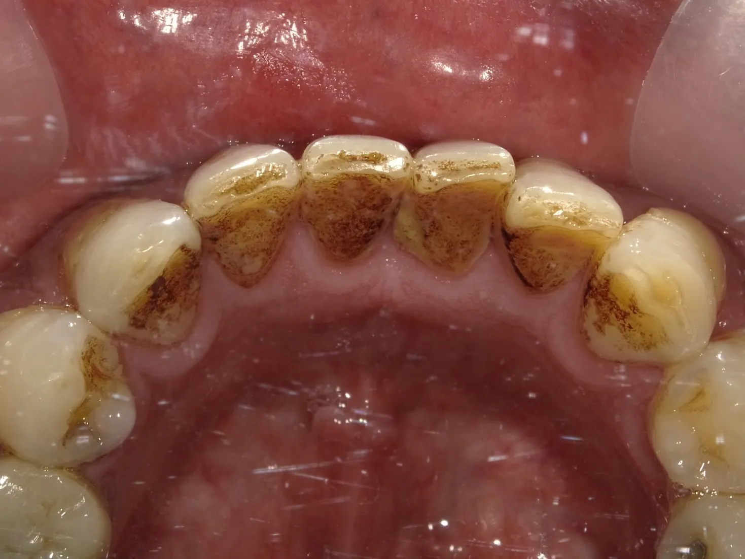 60代男性 ヘビースモーカー