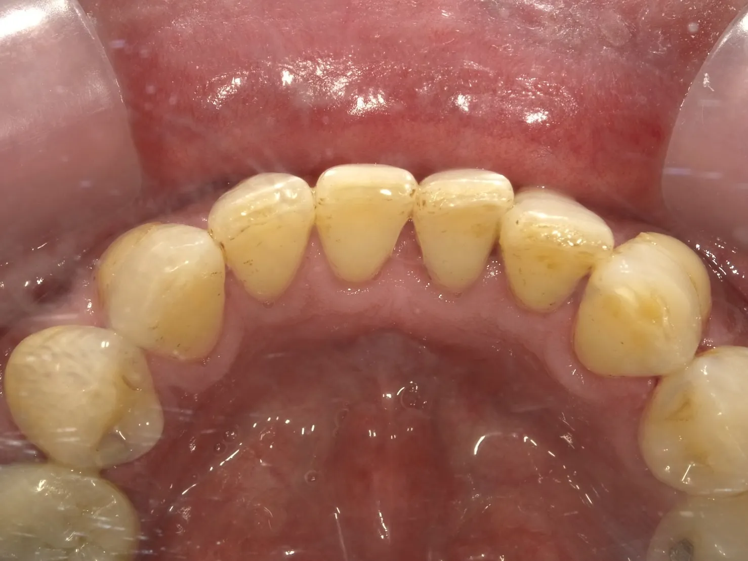 60代男性 ヘビースモーカー