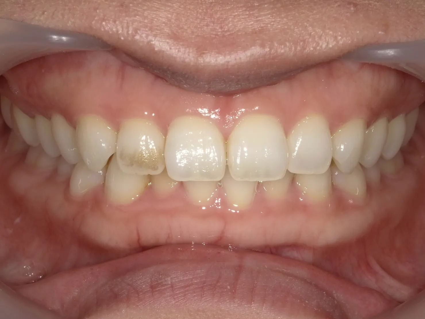 30代女性　右上の前歯