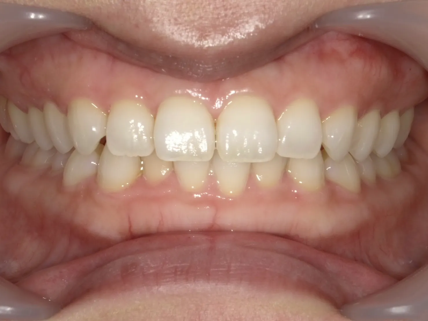 30代女性　右上の前歯