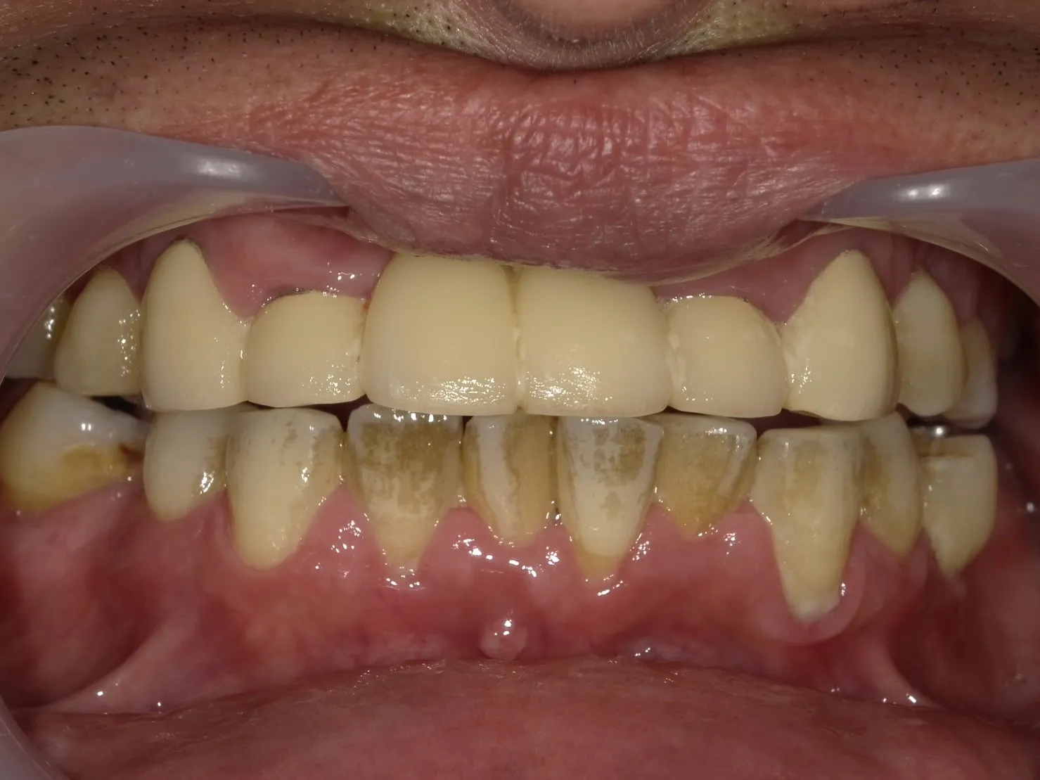 50代男性　ヘビースモーカー