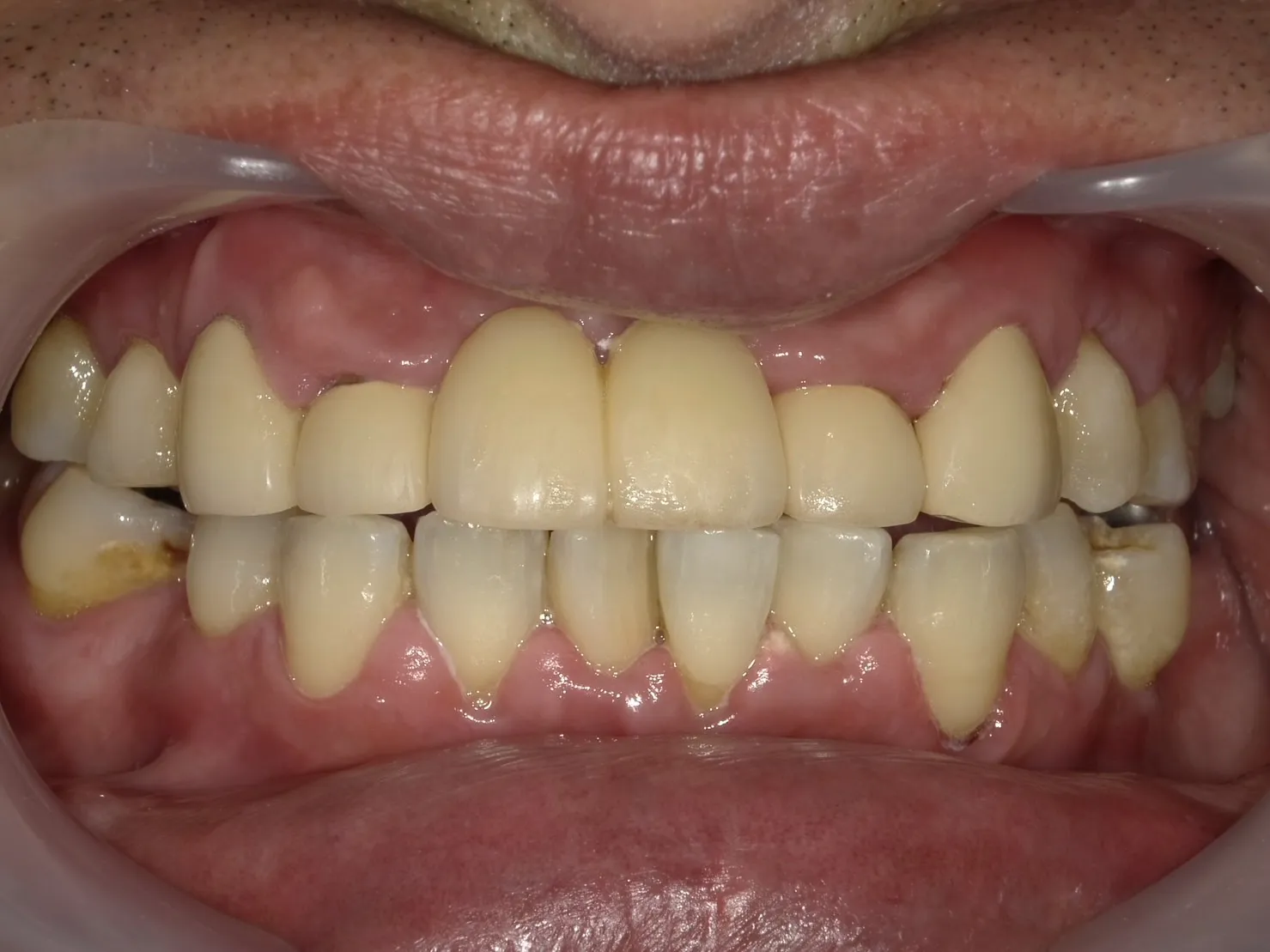 50代男性　ヘビースモーカー