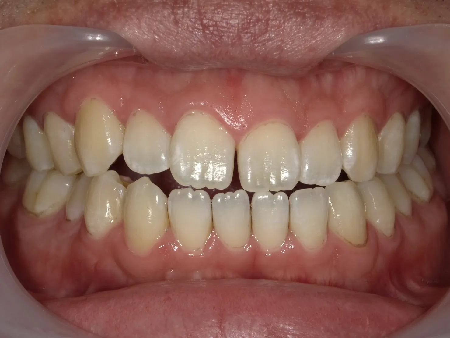 3０代男性コーヒーの着色術後