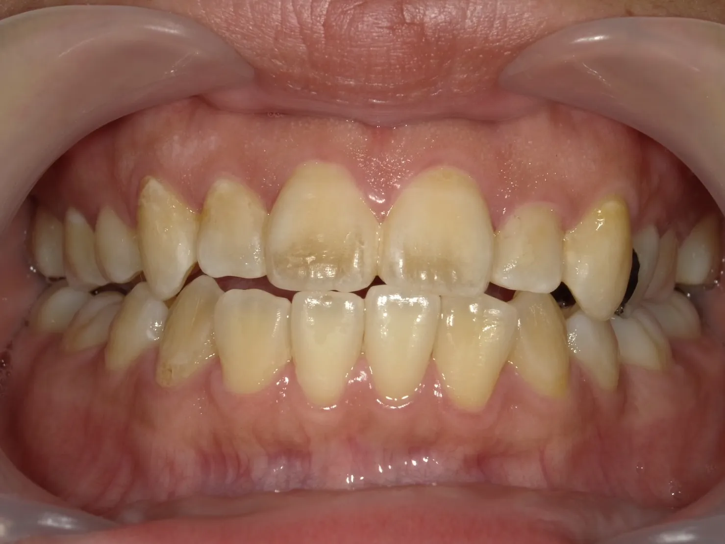 クリーニングホワイトニング