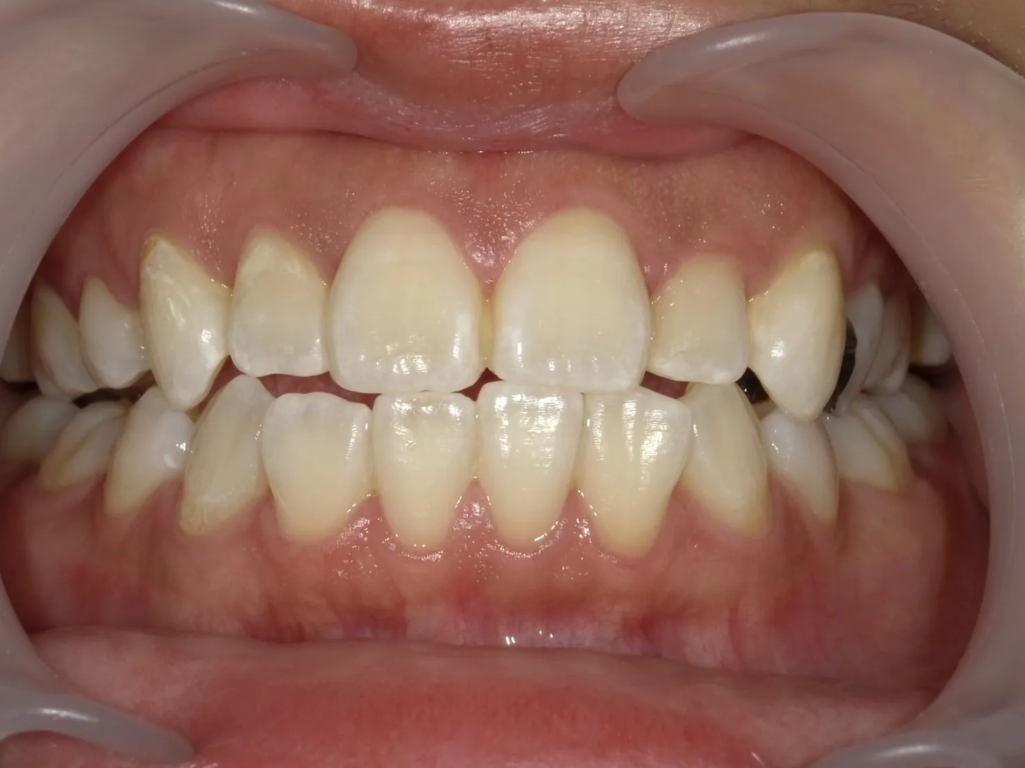 クリーニングホワイトニング