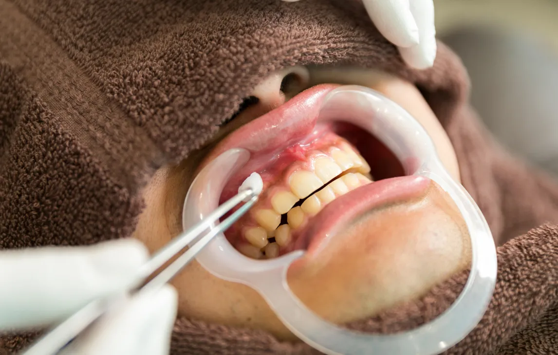 専用の薬剤を歯ぐきに塗布