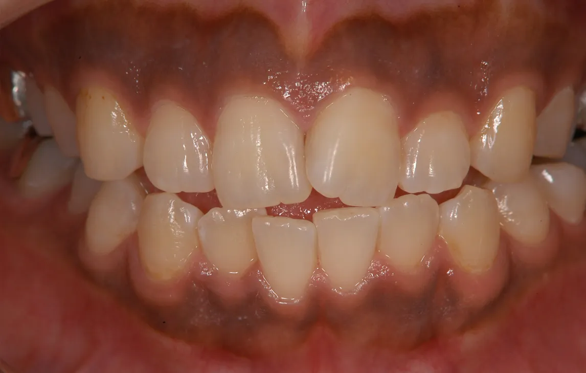 歯ぐきの黒ずみを除去