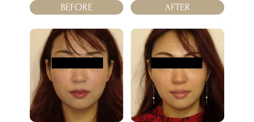 ボツリヌス症例３