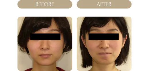 ボツリヌス症例