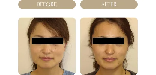 ボツリヌス症例２