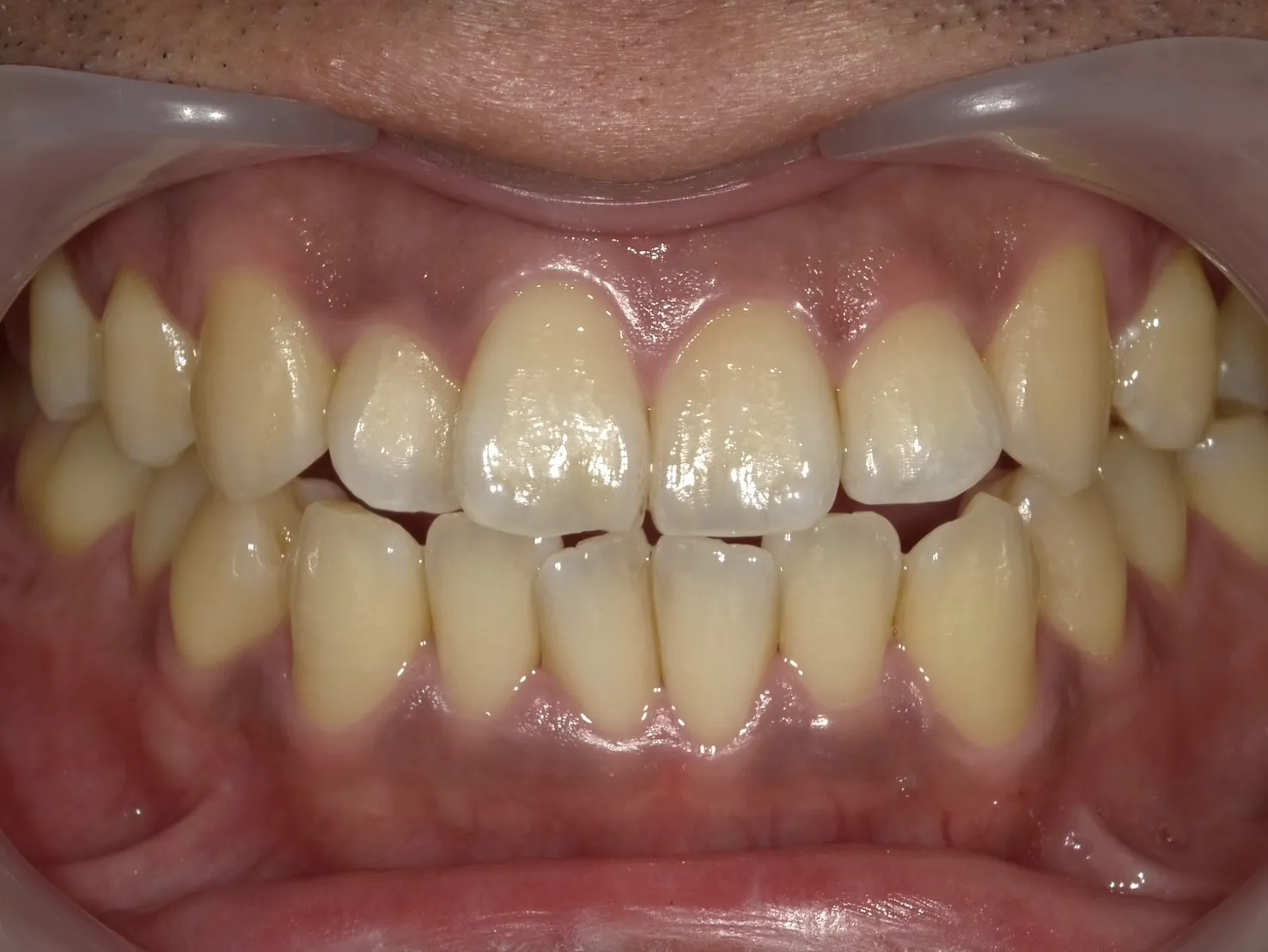 ３０代男性ホワイトニングビフォー