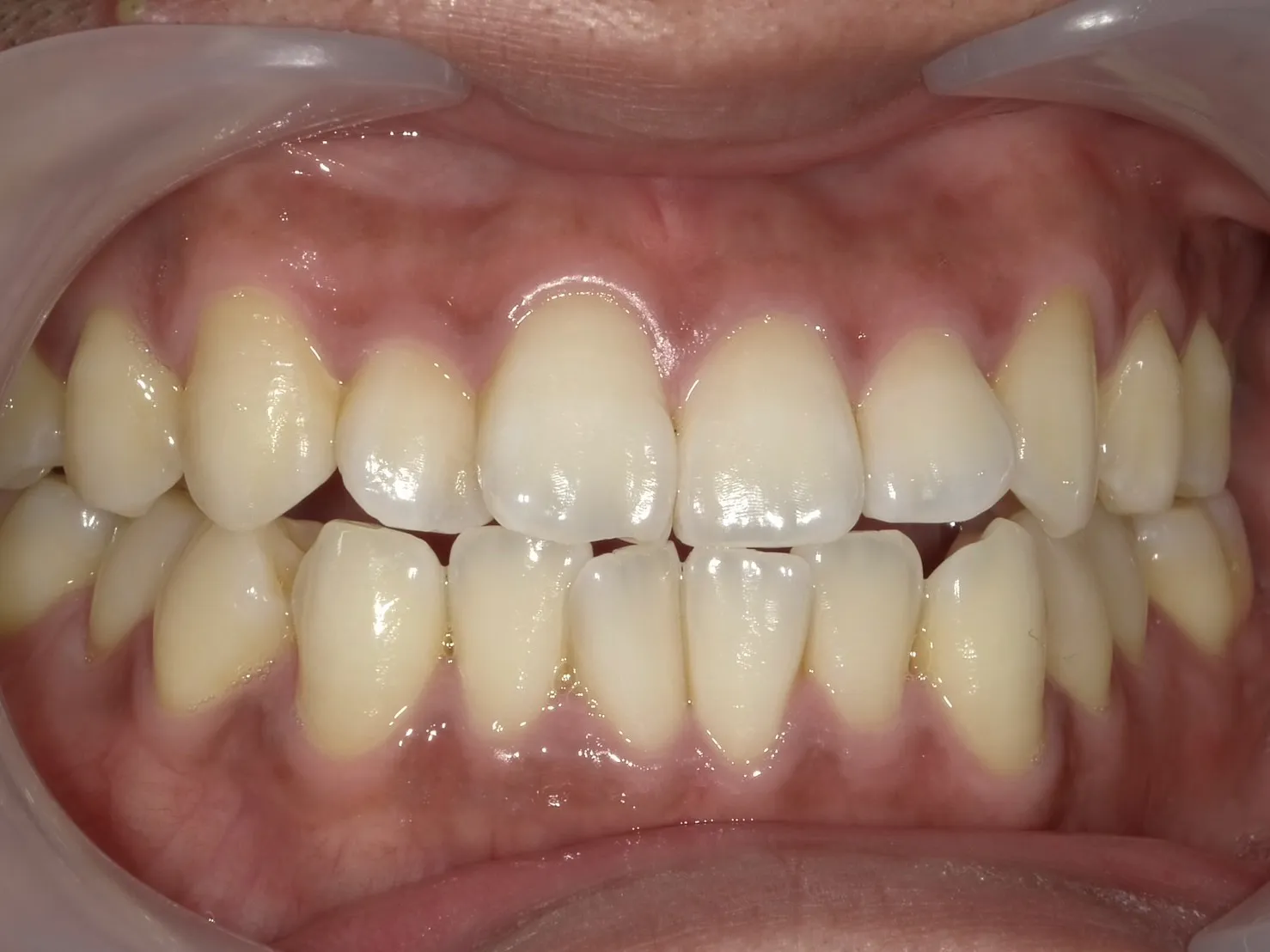 ３０代男性ホワイトニングアフター