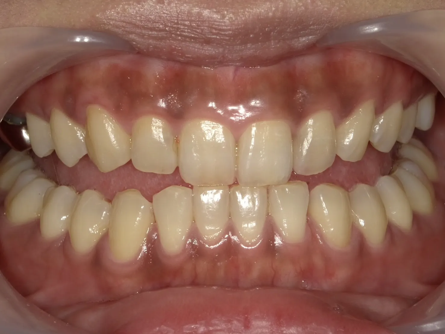 ２０代女性ホワイトニングビフォー