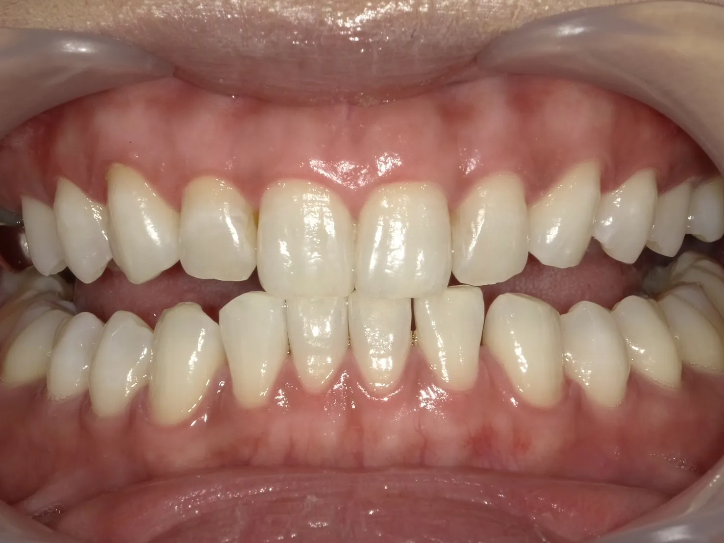 ２０代女性ホワイトニングアフター