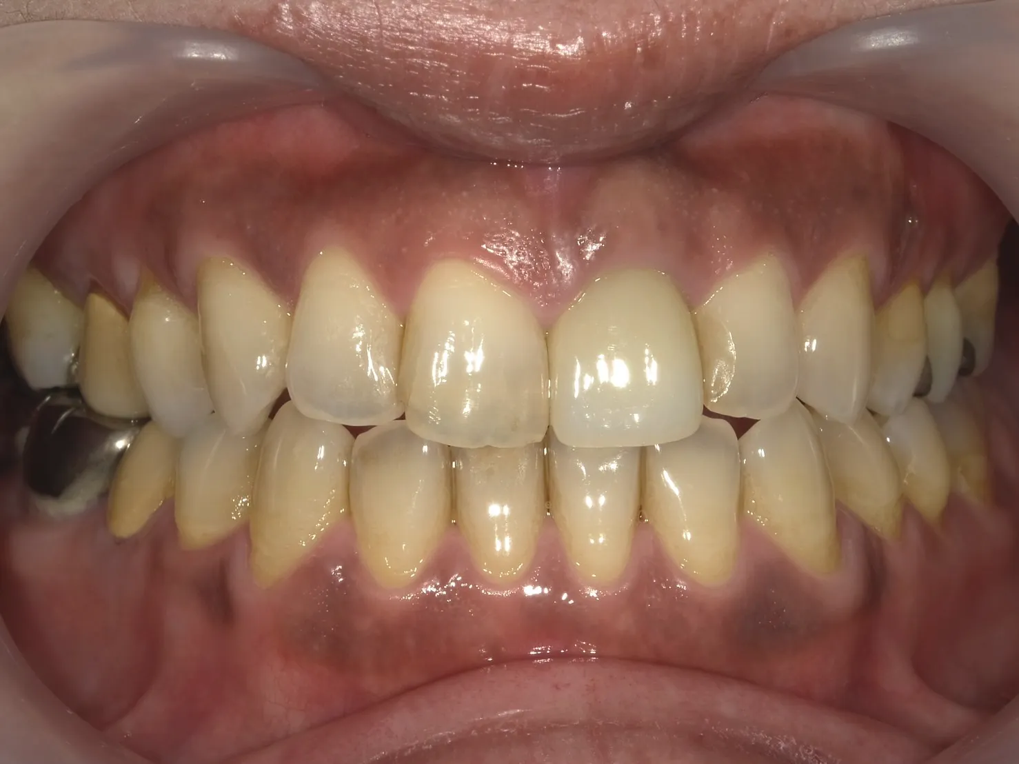 ２０代女性ホワイトニングビフォー