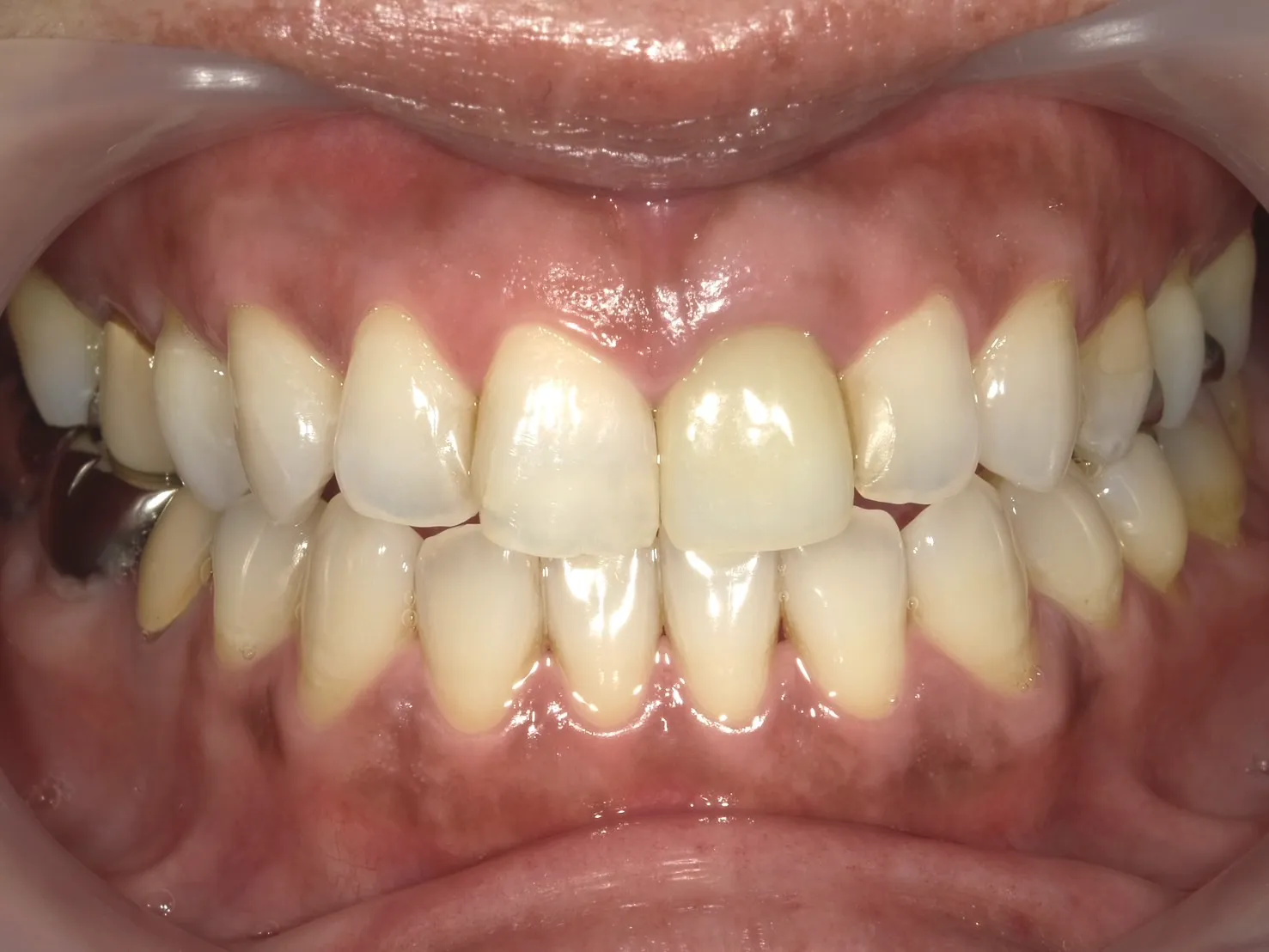 ２０代女性ホワイトニングアフター