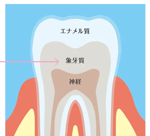 歯の内部にある象牙質の黄ばみ 歯の内部にある象牙質の黄ばみ